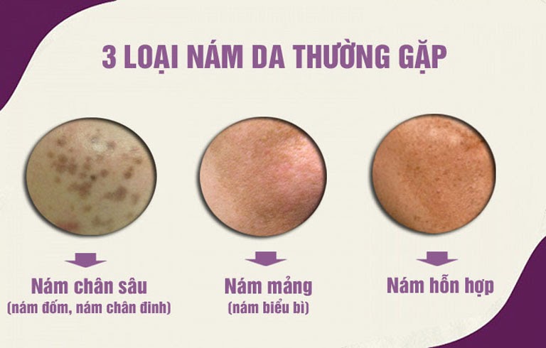 3 Loại nám phổ biến thường gặp