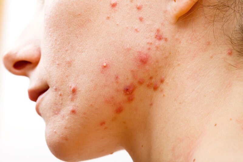 Da mụn là làn da tổn thương và khó chăm sóc