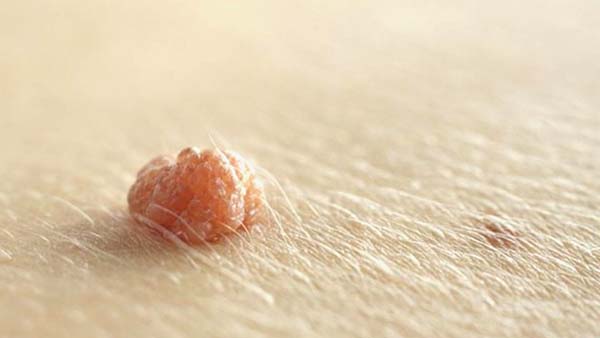 Nhận biết mụn đá hay mụn thịt xuất hiện trên da mặt