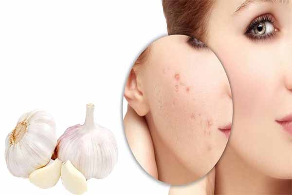 Có thể sử dụng tỏi để điều trị tình trạng mụn trên da mặt