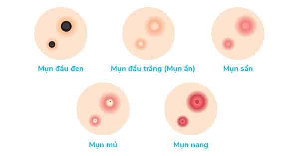 Một số loại mụn khác mà rau diếp cá có thể điều trị được