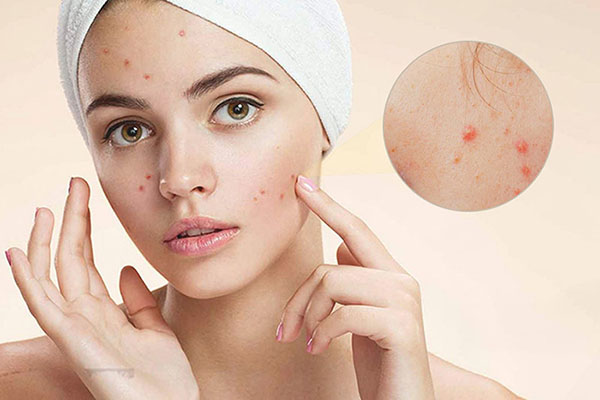 Mụn xuất hiện nhiều trên da và khó điều trị