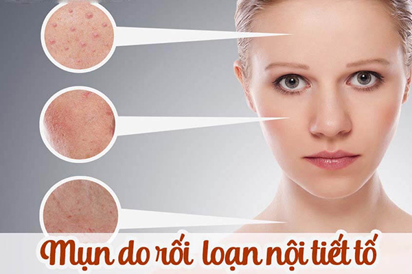 mun do doi loan noi tiet to
