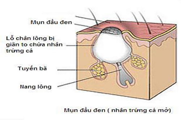Có rất nhiều nguyên nhân gây mụn đầu đen ở mũi