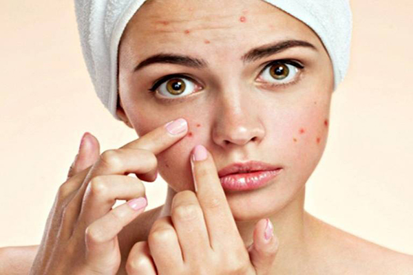 Nặn mụn bằng tay khiến cho tình trạng mụn nghiêm trọng hơn