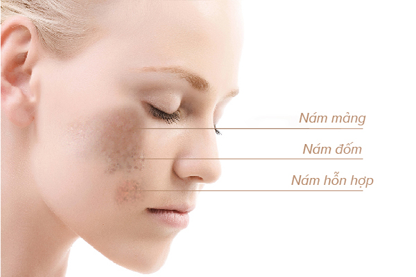 Nám da được phân thành 3 loại: nám mảng, nám chân sâu (nám đốm) và nám hỗn hợp