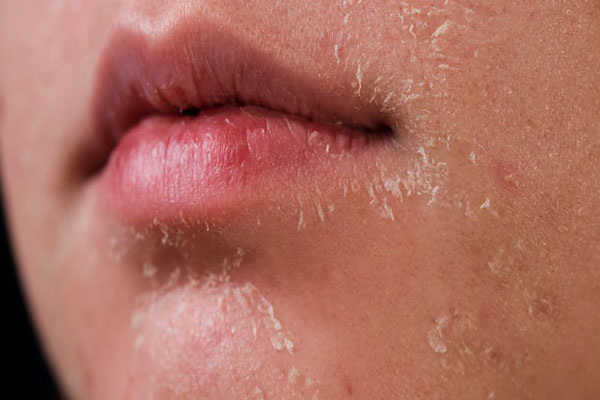 Da có thể bong tróc tổn thương khi lạm dụng muối nở làm đẹp