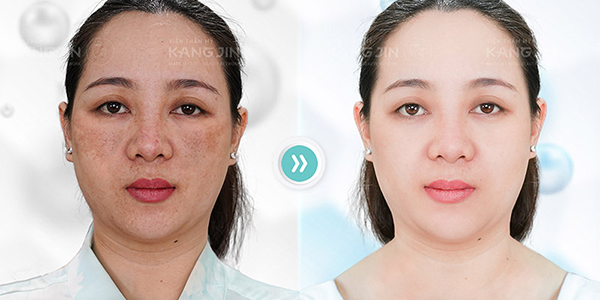 Khách hàng đã trị nám thành công tại VTM KangJin