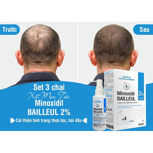 Hiệu quả vượt trội khi sử dụng Minoxidil 2% 60ml