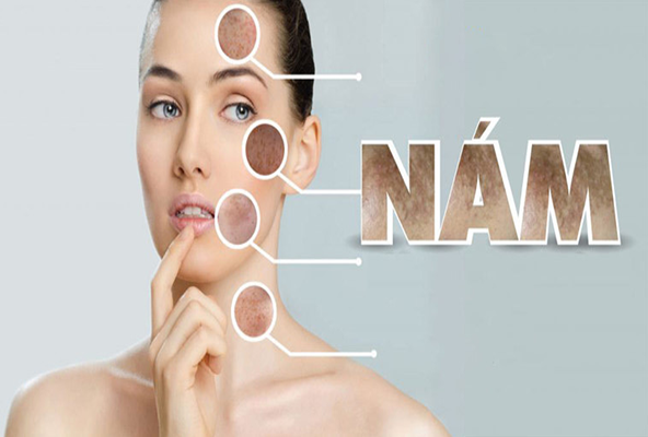 Nám có thể xuất hiện ở nhiều vùng da khác nhau trên cơ thể