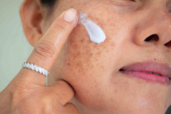 Loại bỏ nám mảng bằng các loại kem bôi đặc trị