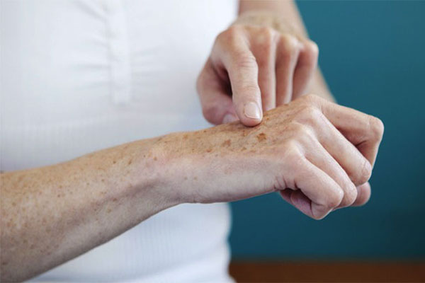 Đốm đen nám có thể xuất hiện trên mu bàn tay mà ít người để ý
