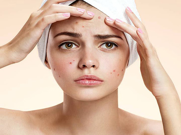 Nổi mụn đỏ trên trán có thể là dấu hiệu của một vài bệnh lý về đường tiêu hóa