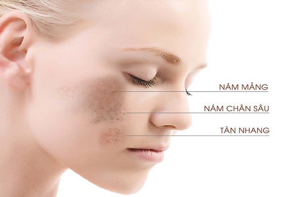 Nám xuất hiện trên da mặt gây mất thẩm mỹ