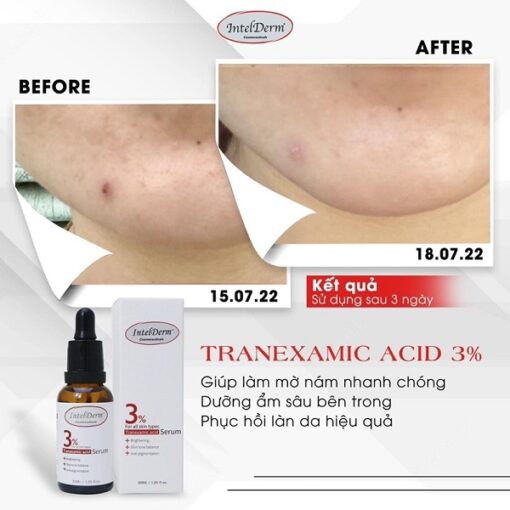 Intelderm 3% Tranexamic Acid Serum Hỗ Trợ Giảm Nám Tàn Nhang 30ml