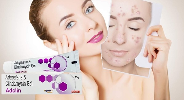 Hỗ trợ giảm mụn nhanh chóng và hiệu quả